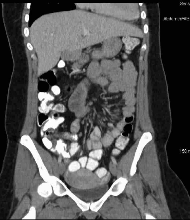 Ct Scan Of Stomach What Does It Show