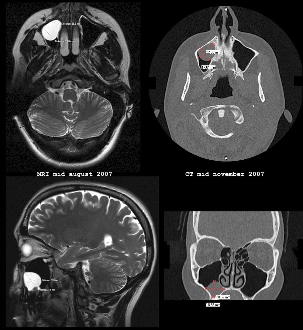 CT vs. MRI