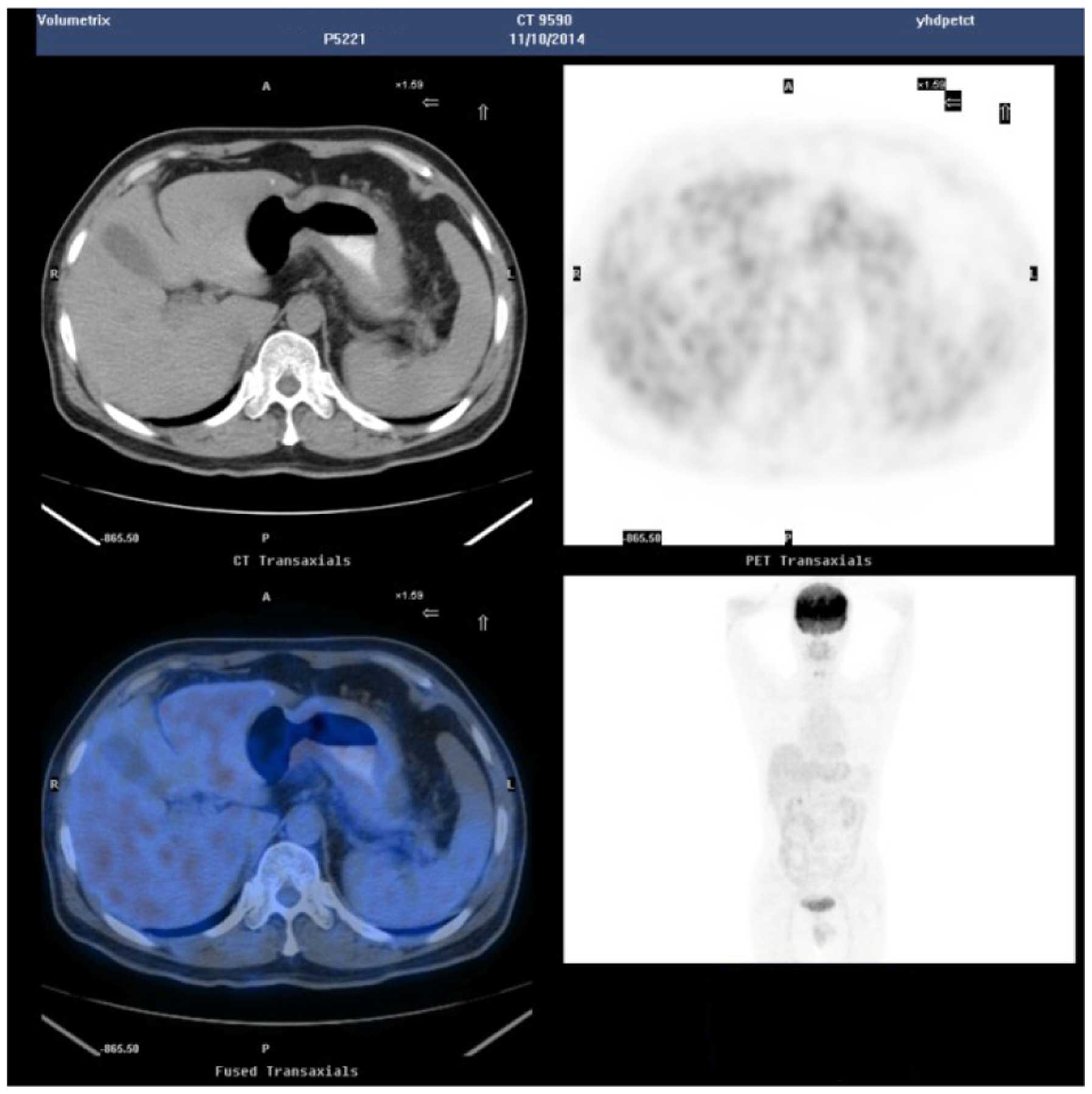 Stomach Cancer Ct Scan Images